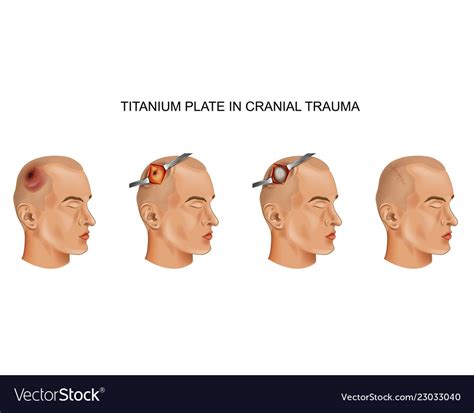 Titanium Plate In Traumatic Brain Injury Vector Image