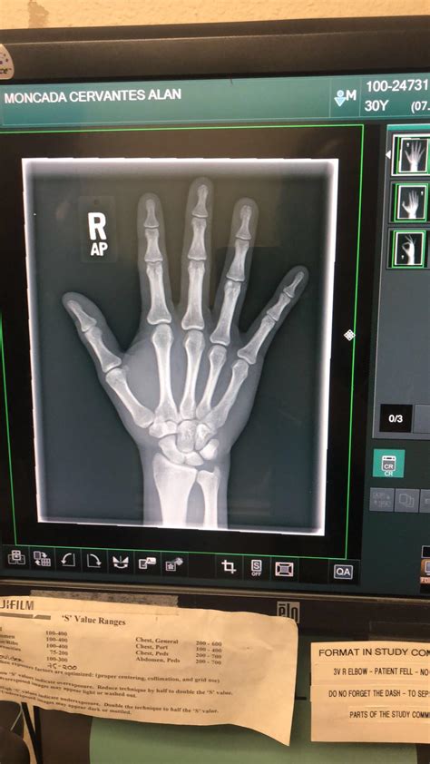 Broken tip on ring finger : r/xrays