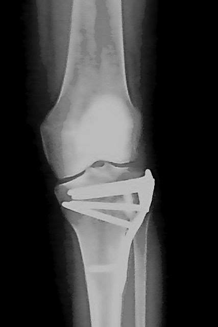 My Tibial Plateau Fracture (TPF) Rehab & Recovery | Tibial plateau ...