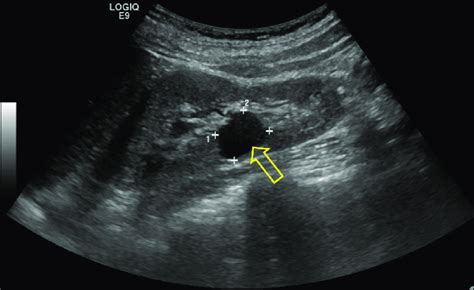 Renal Sinus Cyst