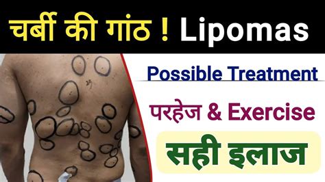 charbi ki ganth ka ilaaj lipoma best medicine चरब क गठ