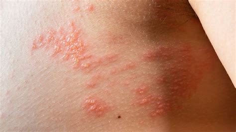 Shingles Know Its Causes Symptoms And Treatment Onlymyhealth