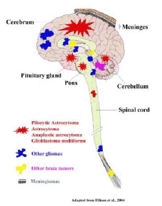 Cancer: Types Of Brain Cancer