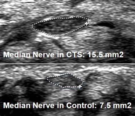 Median Nerve Ultrasound