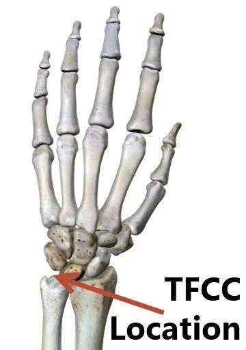 Right Wrist Tfcc Ligament Tear