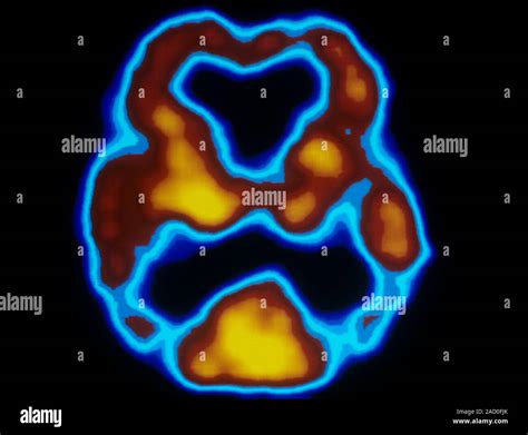 La Actividad Cerebral En La Enfermedad De Alzheimer Una Sola