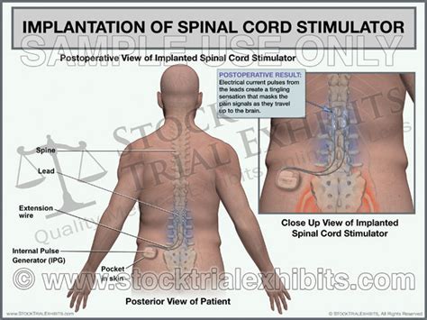 Lumbar Spinal Cord Stimulator Implantation Trial Exhibit Male Stock Trial Exhibits