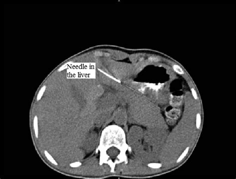 Ct Abdomen Without Contrast Showing The Needle In The Left Lobe Of The Download Scientific