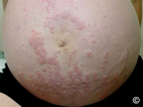 Pruritic Folliculitis Of Pregnancy