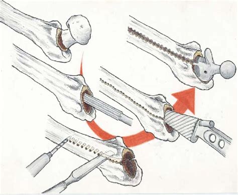 Enlargement of the medullary canal of the femur | Download Scientific Diagram