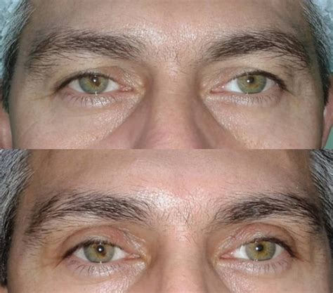 Blefaroplastia fotos Recomendaciones y Guía 2019