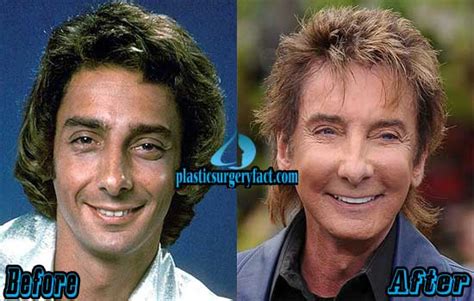 Barry Manilow Plastic Surgery Before And After Photos