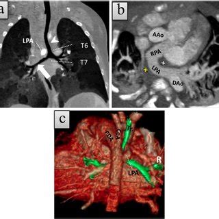 Month Old Girl With Type B Left Pulmonary Artery Sling Lpas With