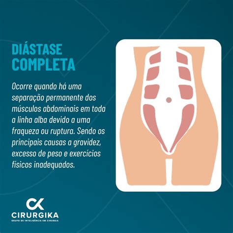 Diástase abdominal entenda o que é e suas principais causas Clínica