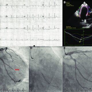 Twelve Lead Electrocardiogram Transthoracic Echocardiography And