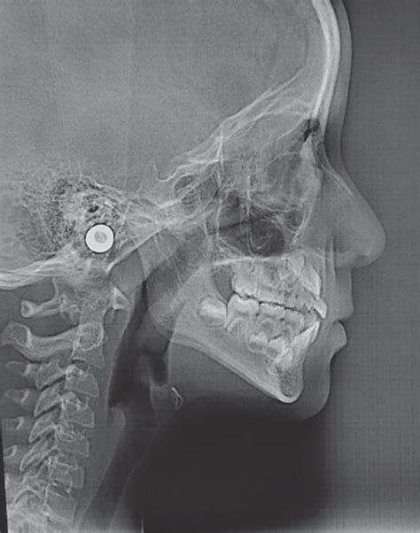 The lateral cephalic radiography shows skeletal Class III due to mild ...