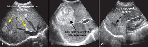 Ultrasonido Lesiones Focales Del H Gado Gastro M Rida