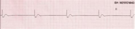 Ventricular Dysrhythmias Flashcards Quizlet