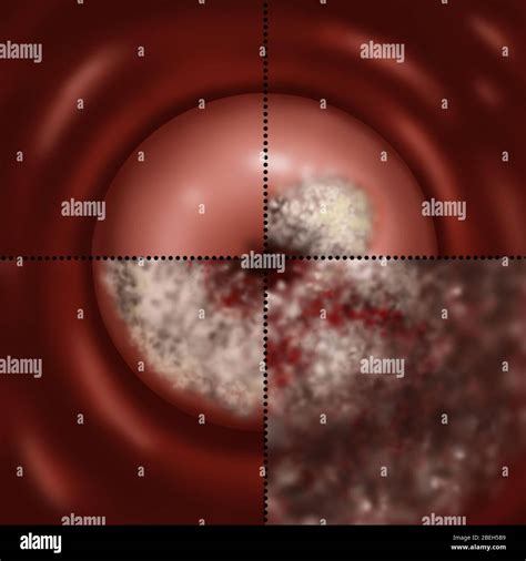 Progresi N Del C Ncer Cervical Ilustraci N Fotograf A De Stock Alamy