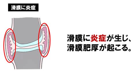 関節リウマチについて正しいのはどれか【第53回理学療法士国家試験am87】 — 理学療法士国家試験対策ptes