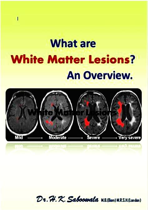 What are White Matter Lesions? An Overview. eBook by Dr. Hakim. K ...