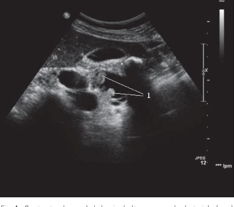 [pdf] Type Ii Intrapancreatic Choledochal Malignant Cyst In Adults Duodenopancreatectomy