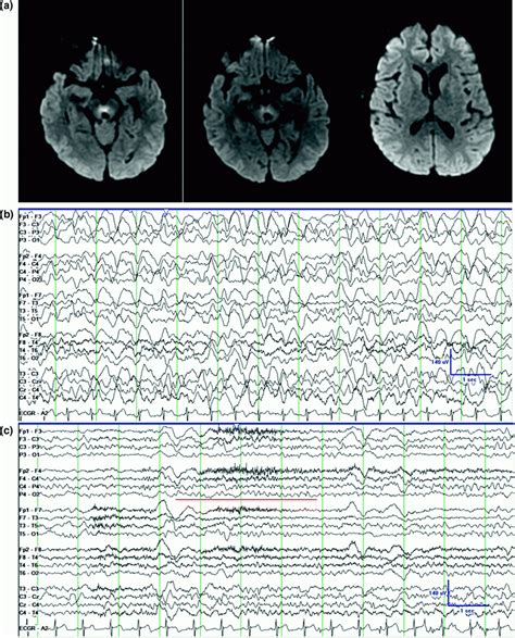 Periodic Eeg Patterns Neupsy Key