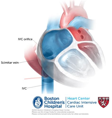 Scimitar Syndrome Online Supplement