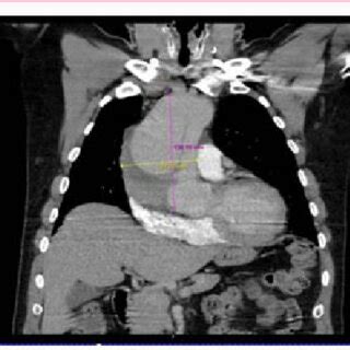 Pre-OP CT-Scan: Axial: Ascending and descending aorta. | Download ...