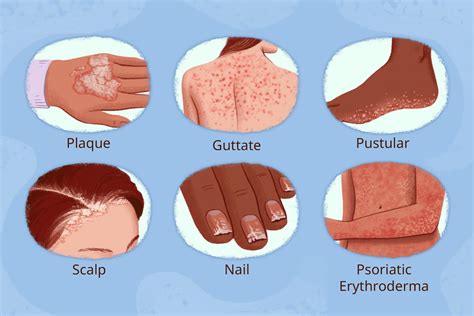 Types Of Psoriasis MEDizzy