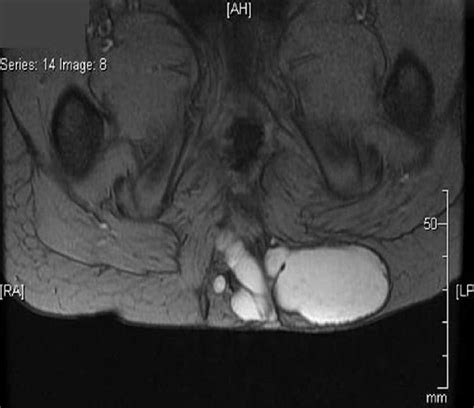 Magnetic Resonance Imaging Showing Large Tumor In The Presacral Region