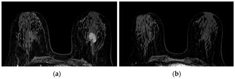 Jpm Free Full Text Response Predictivity To Neoadjuvant Therapies