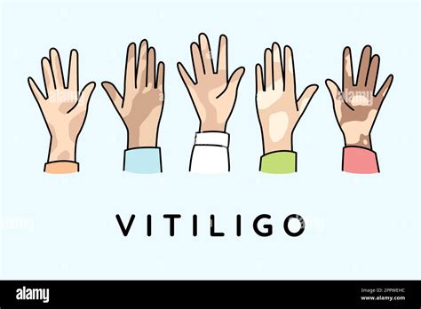 People hands with vitiligo Stock Vector Image & Art - Alamy