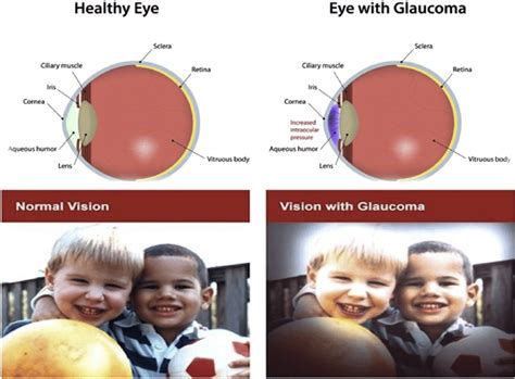 Glaucoma Vision : Causes of vision loss worldwide — м.: | me-stardoll