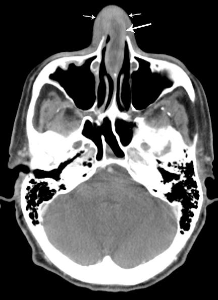 Figure 1 From Nasal Septal Abscess In Patients With Immunosuppression