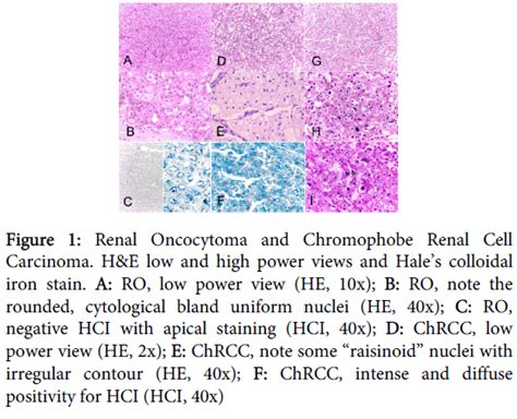 Clinical Experimental Pathology Chromophobe Renal Cell