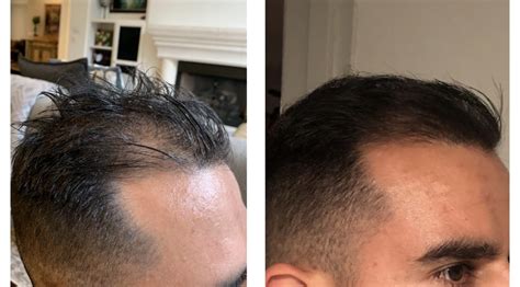 Hair Restoration Austin Regenerative Therapy