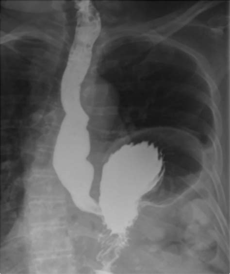 Endoscopic Reduction Of Type Iv Paraesophageal Hernia Videogie