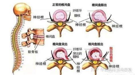 腰椎间盘突出能运动吗？ 知乎