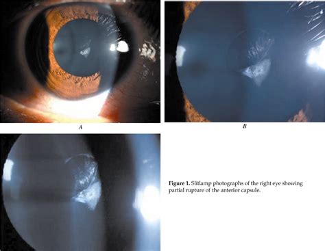 Figure From Bilateral Spontaneous Rupture Of The Anterior Capsule