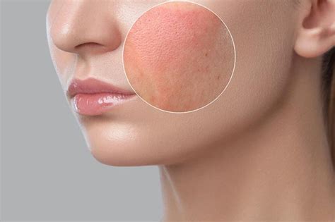 Migliori Rimedi Naturali Per La Pelle Irritata Ecco Come Alleviare Le