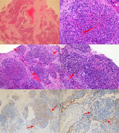 Microscopic Low And High Power Views A Tumor Composed Of Nodules