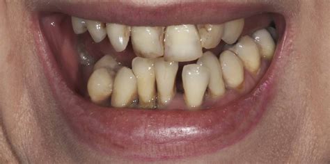 All on 4: Before and After Gallery - Dental 99 Implant Institute