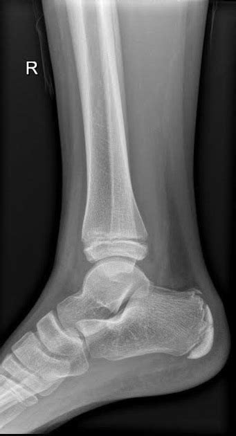 Normal Pediatric Ankle Xray