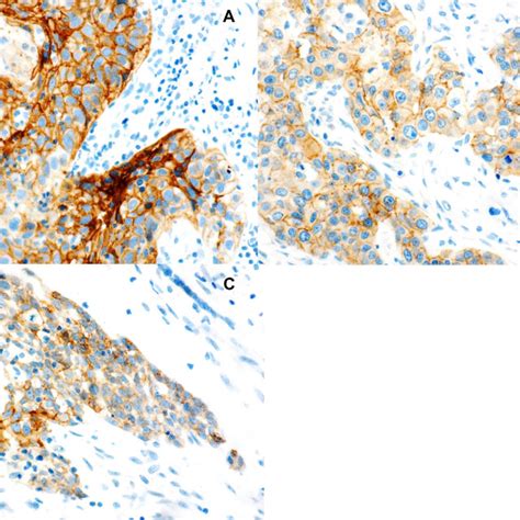 Immunohistochemical Staining For E Cadherin Expression A Early Download Scientific Diagram