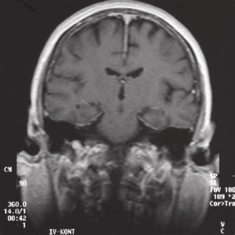 MRI scans showing diffuse pachymeningeal contrast enhancement and mild ...