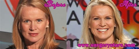 Katty Kay Plastic Surgery Before and After Photos