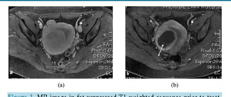 Figure From Percutaneous Ultrasound Guided Radiofrequency Thermal