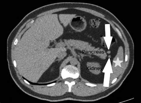 Transverse Ct Scan Of Accessory Spleen At Pancreatic Tail Accessory