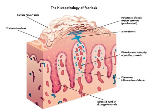 Understanding Scalp Psoriasis - Healthier Steps